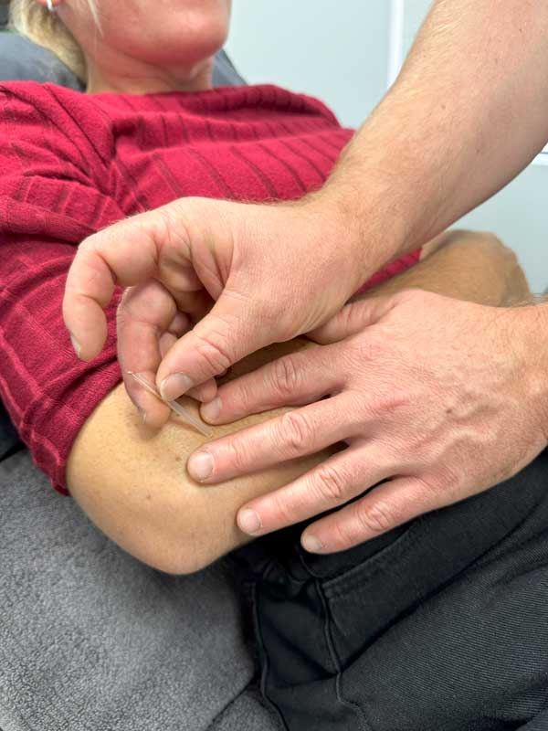 Dry Needling at ARC Physiotherapy Dry Needling at ARC Physiotherapy