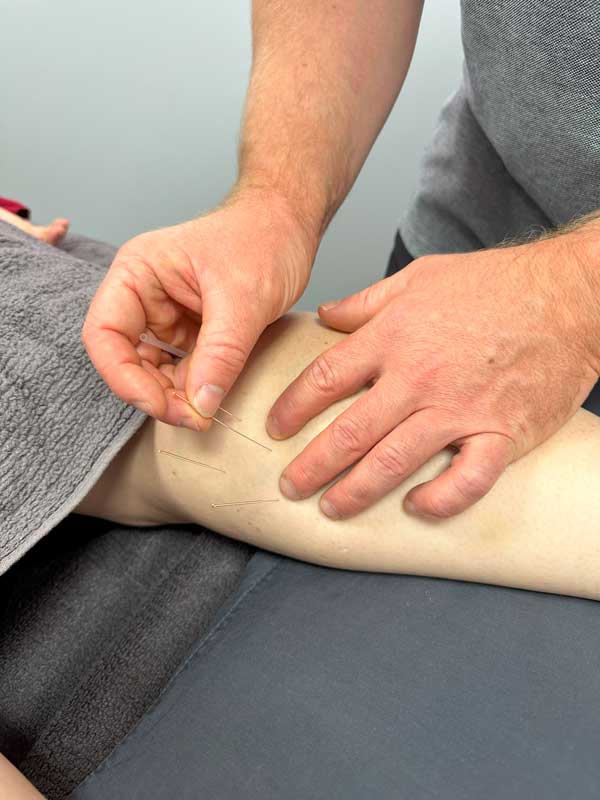 Dry Needling at ARC Physiotherapy Dry Needling at ARC Physiotherapy